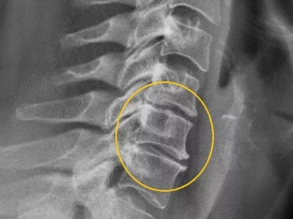 Osteochondroza coloanei vertebrale cervicale pe o rază X