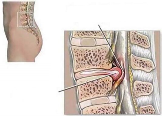 Hernia intervertebrală provoacă dureri de spate