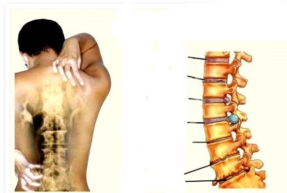 Osteochondroza este cauza durerilor de spate