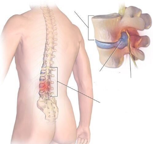 Radiculita este un proces inflamator în departamentul Lumbosacral