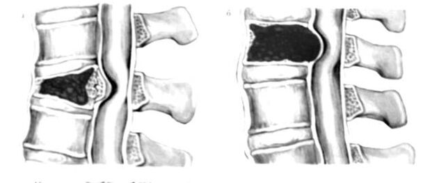 Tumora din coloana vertebrală este cauza durerilor de spate